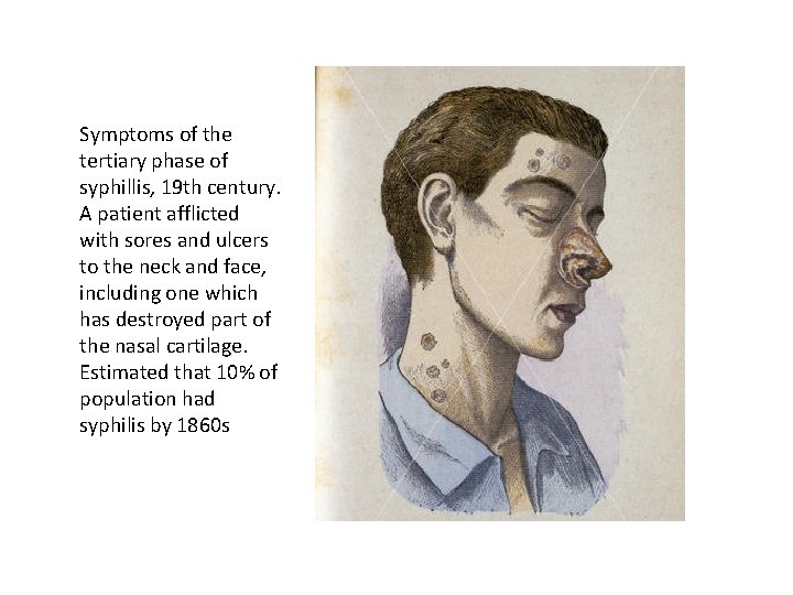 Symptoms of the tertiary phase of syphillis, 19 th century. A patient afflicted with