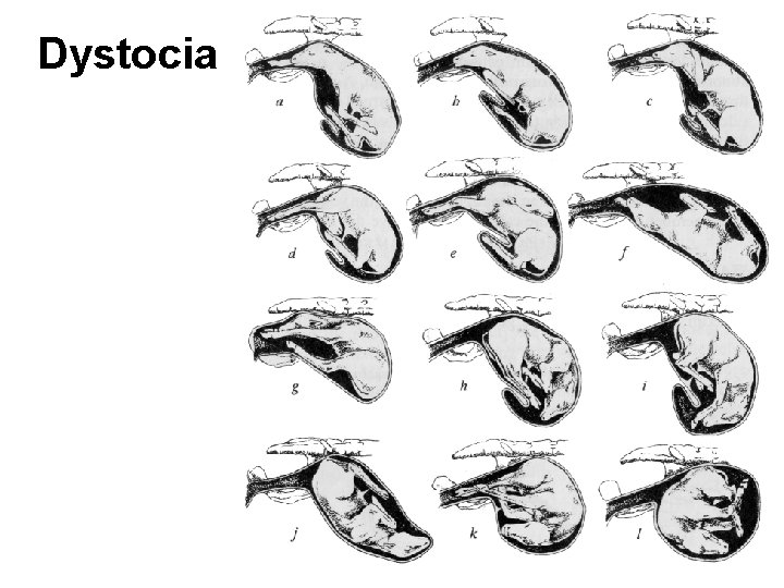 Dystocia 