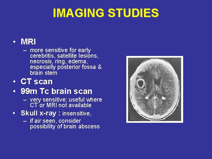 IMAGING STUDIES • MRI – more sensitive for early cerebritis, satellite lesions, necrosis, ring,