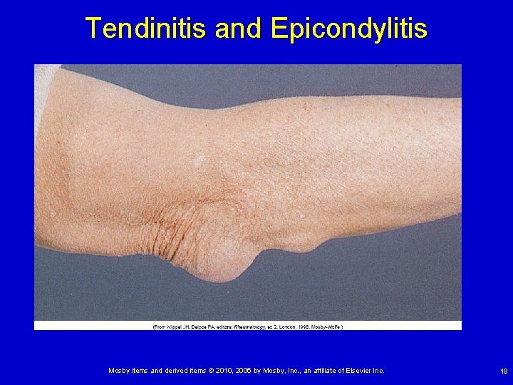 Tendinitis and Epicondylitis Mosby items and derived items © 2010, 2006 by Mosby, Inc.