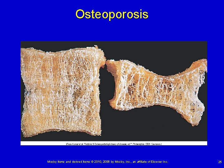 Osteoporosis Mosby items and derived items © 2010, 2006 by Mosby, Inc. , an