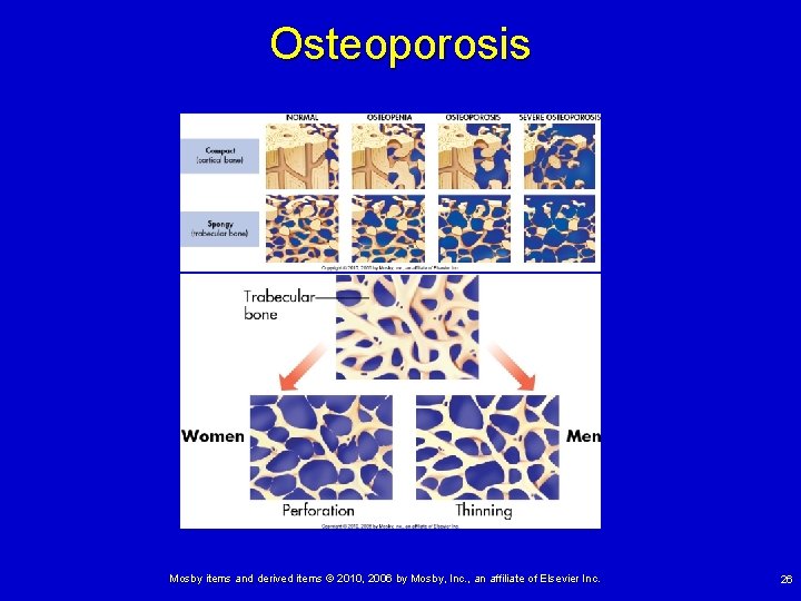 Osteoporosis Mosby items and derived items © 2010, 2006 by Mosby, Inc. , an
