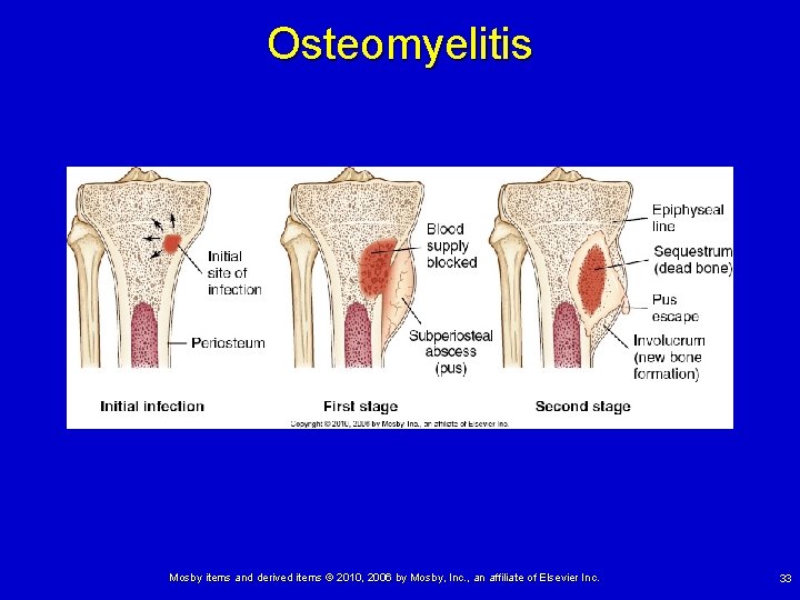 Osteomyelitis Mosby items and derived items © 2010, 2006 by Mosby, Inc. , an