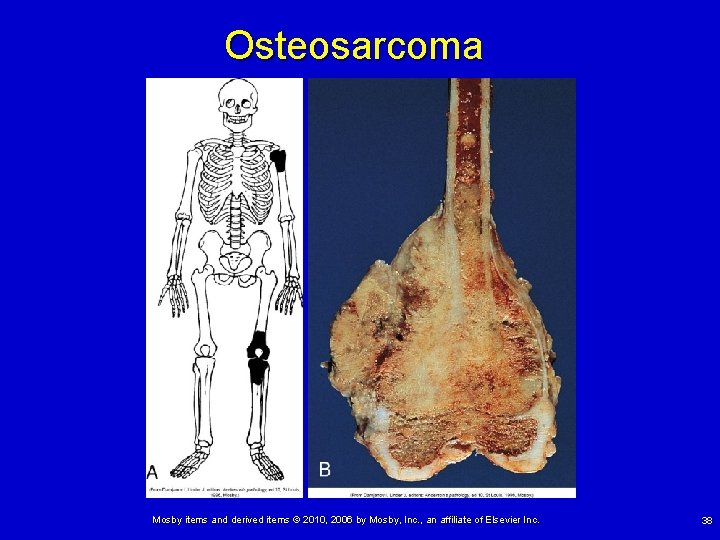 Osteosarcoma Mosby items and derived items © 2010, 2006 by Mosby, Inc. , an