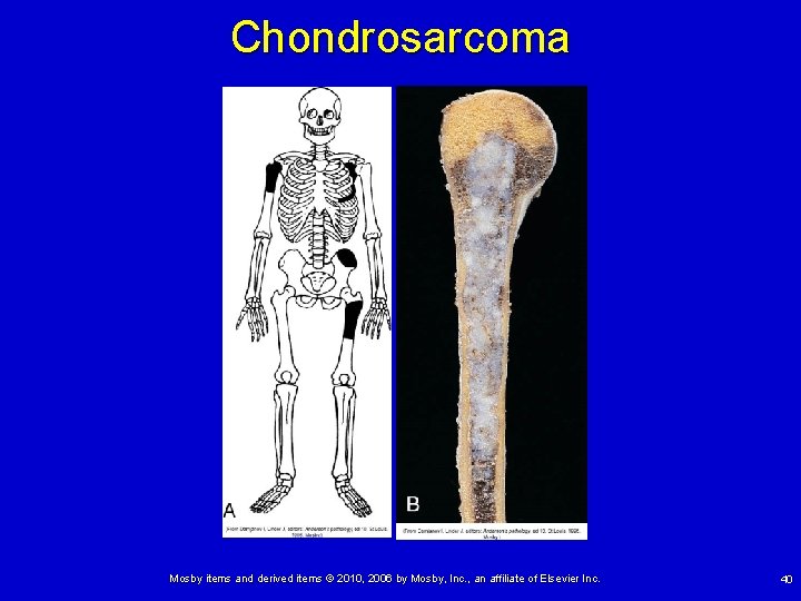 Chondrosarcoma Mosby items and derived items © 2010, 2006 by Mosby, Inc. , an