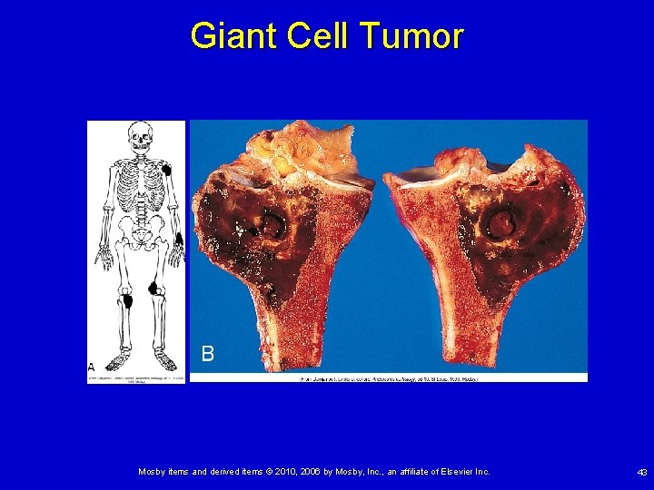 Giant Cell Tumor Mosby items and derived items © 2010, 2006 by Mosby, Inc.