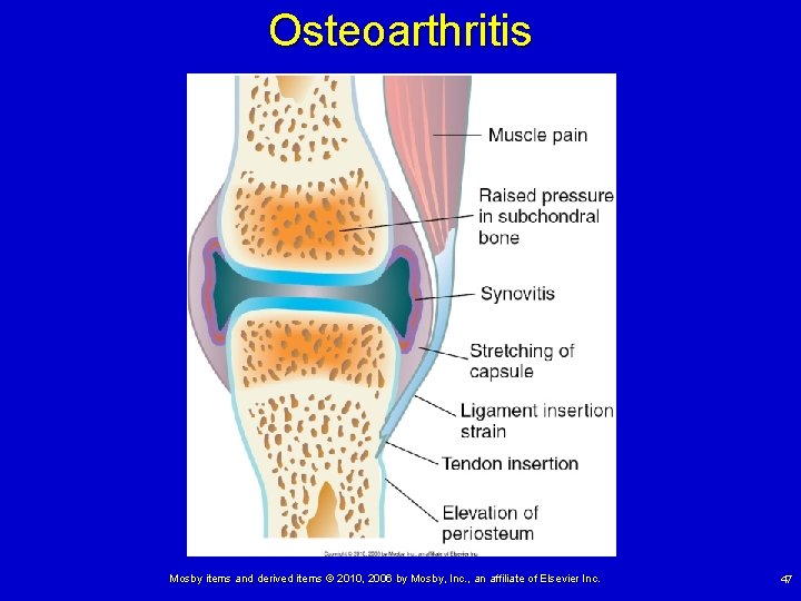 Osteoarthritis Mosby items and derived items © 2010, 2006 by Mosby, Inc. , an