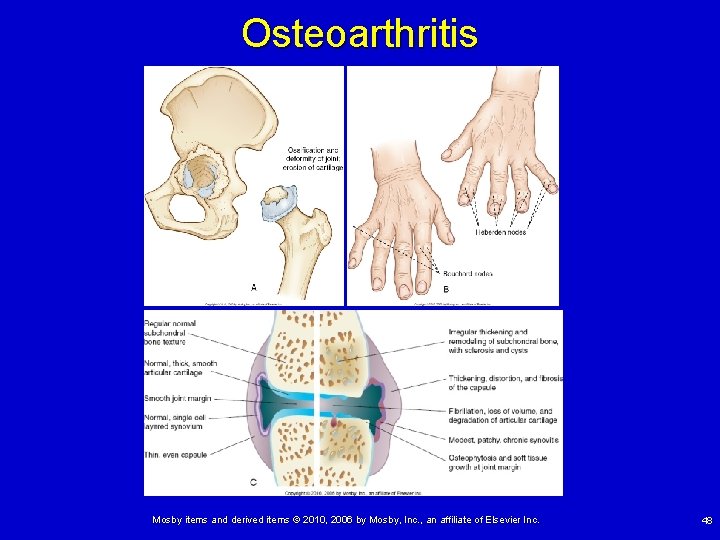 Osteoarthritis Mosby items and derived items © 2010, 2006 by Mosby, Inc. , an