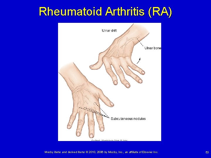 Rheumatoid Arthritis (RA) Mosby items and derived items © 2010, 2006 by Mosby, Inc.