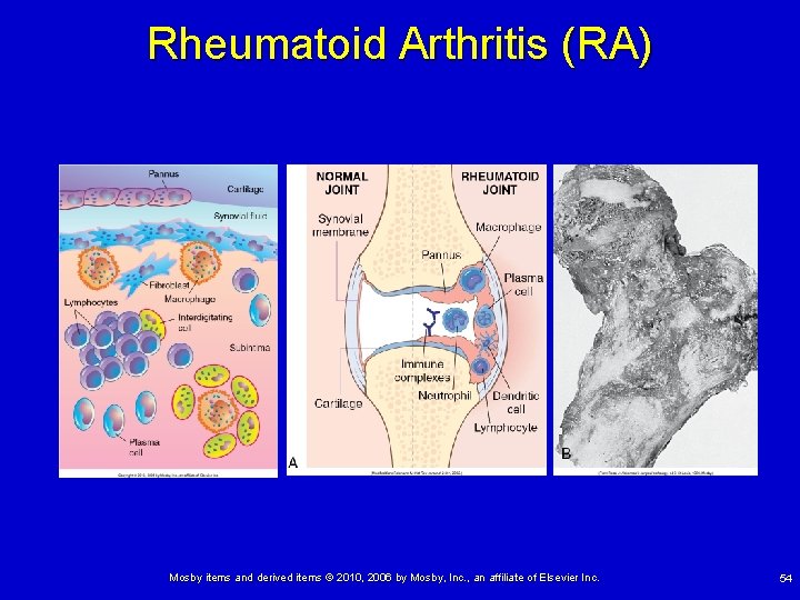 Rheumatoid Arthritis (RA) Mosby items and derived items © 2010, 2006 by Mosby, Inc.