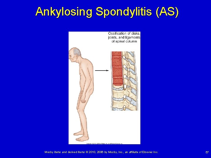 Ankylosing Spondylitis (AS) Mosby items and derived items © 2010, 2006 by Mosby, Inc.