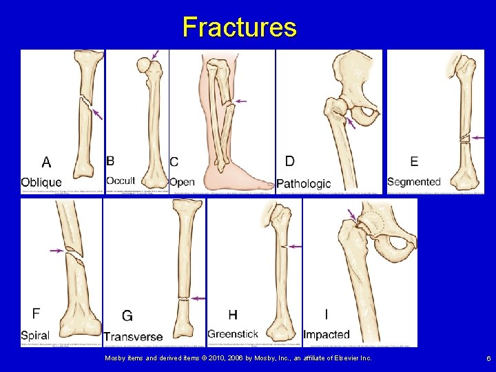 Fractures Mosby items and derived items © 2010, 2006 by Mosby, Inc. , an