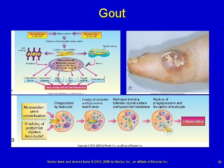 Gout Mosby items and derived items © 2010, 2006 by Mosby, Inc. , an