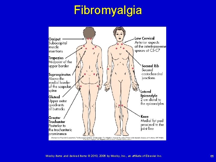Fibromyalgia Mosby items and derived items © 2010, 2006 by Mosby, Inc. , an