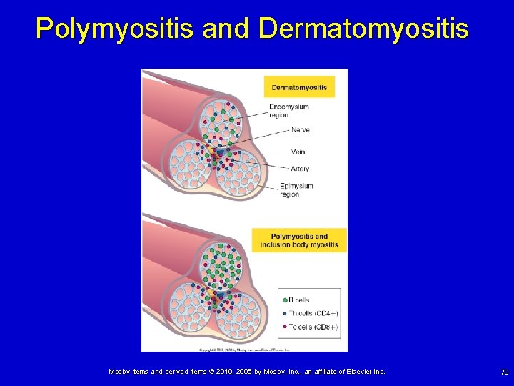 Polymyositis and Dermatomyositis Mosby items and derived items © 2010, 2006 by Mosby, Inc.