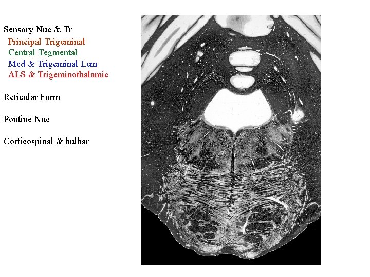 Sensory Nuc & Tr Principal Trigeminal Central Tegmental Med & Trigeminal Lem ALS &