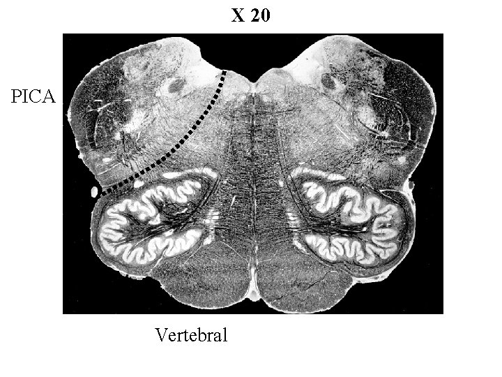 X 20 PICA Vertebral 