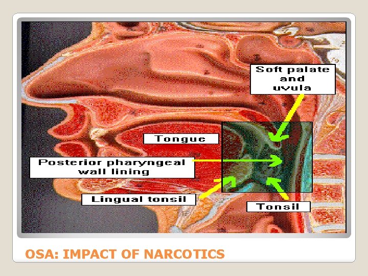 OSA: IMPACT OF NARCOTICS 