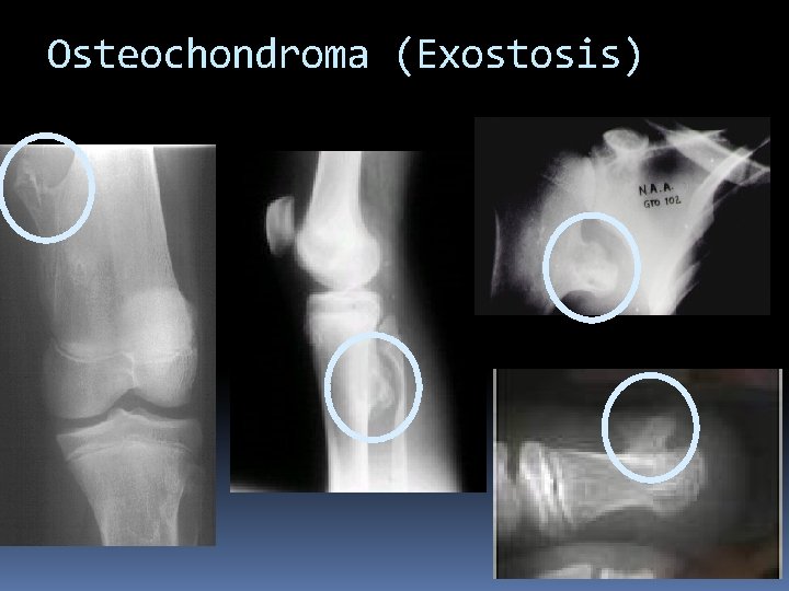 Osteochondroma (Exostosis) 