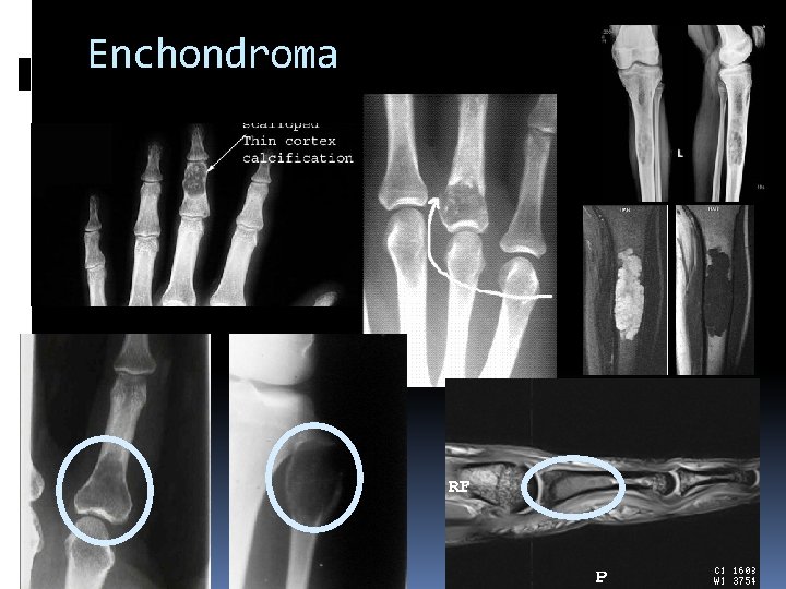 Enchondroma 
