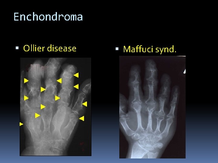 Enchondroma Ollier disease Maffuci synd. 