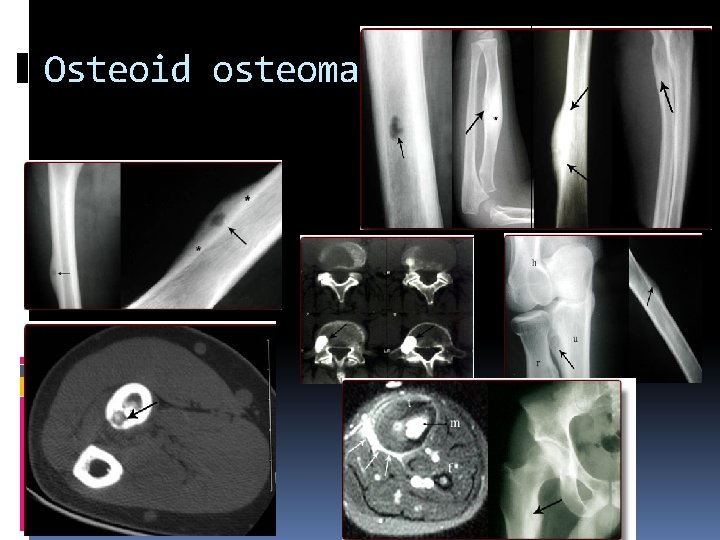 Osteoid osteoma 