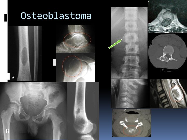 Osteoblastoma 