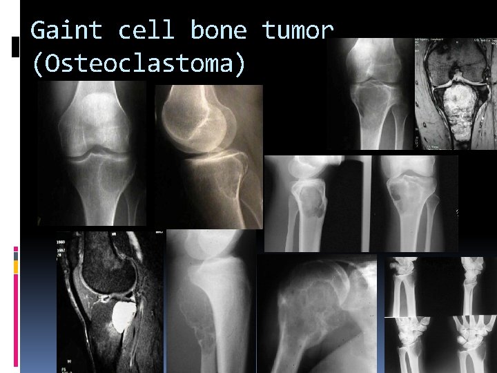 Gaint cell bone tumor (Osteoclastoma) 