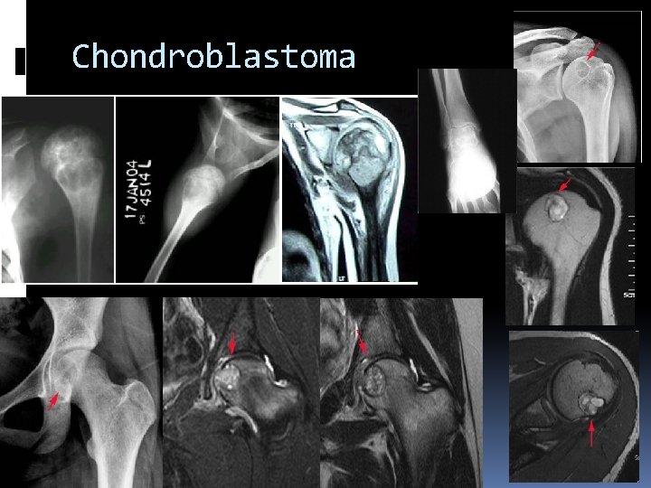 Chondroblastoma 