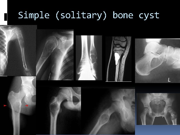 Simple (solitary) bone cyst 