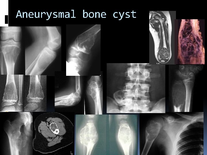 Aneurysmal bone cyst 