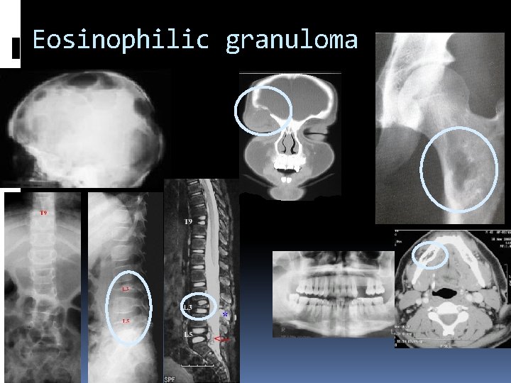 Eosinophilic granuloma 