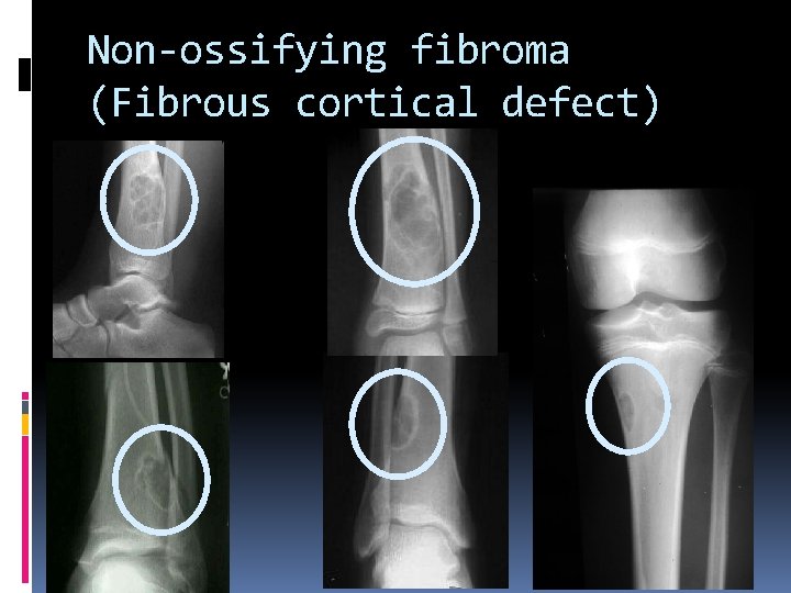 Non-ossifying fibroma (Fibrous cortical defect) 