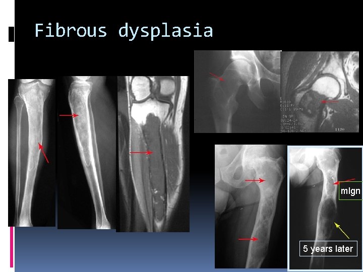 Fibrous dysplasia mlgn 5 years later 