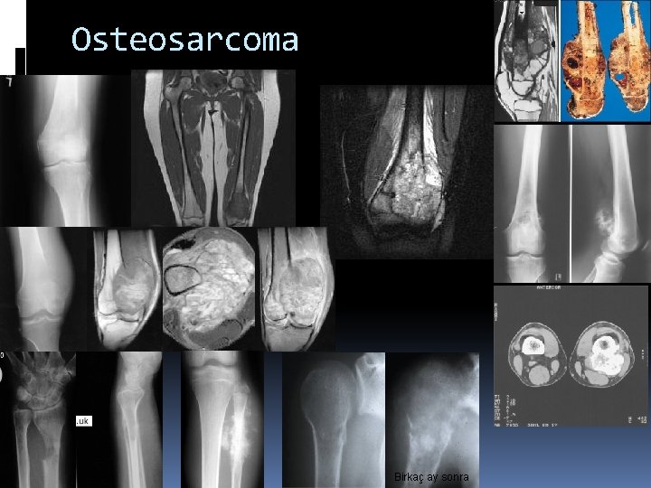 Osteosarcoma Birkaç ay sonra 