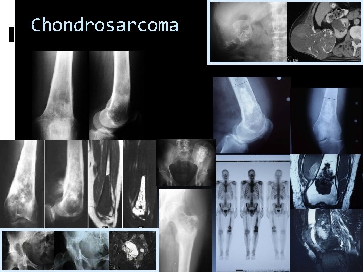 Chondrosarcoma 