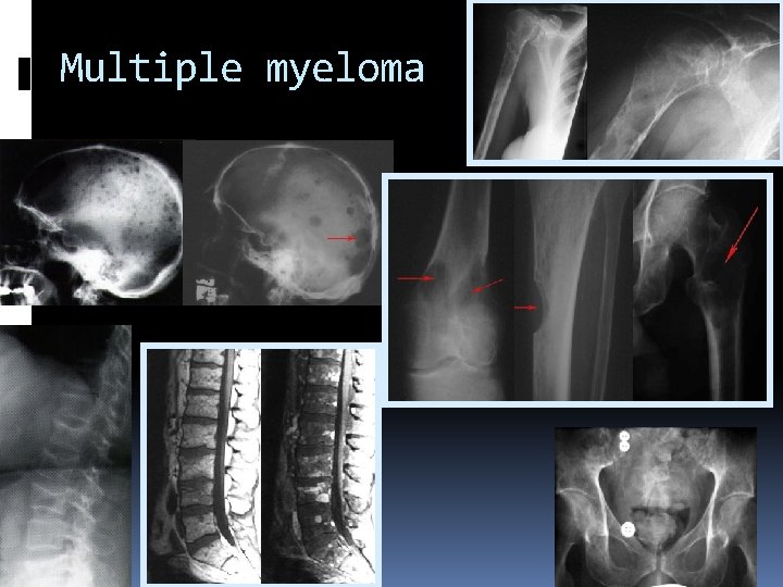 Multiple myeloma 
