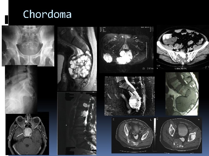 Chordoma 