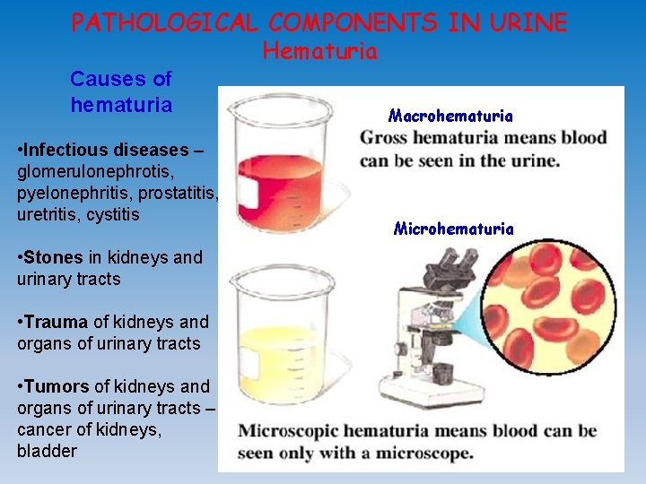 PATHOLOGICAL COMPONENTS IN URINE Hematuria Causes of hematuria • Infectious diseases – glomerulonephrotis, pyelonephritis,