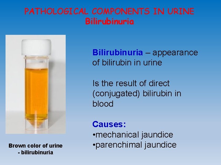 PATHOLOGICAL COMPONENTS IN URINE Bilirubinuria – appearance of bilirubin in urine Is the result