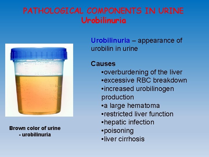 PATHOLOGICAL COMPONENTS IN URINE Urobilinuria – appearance of urobilin in urine Brown color of