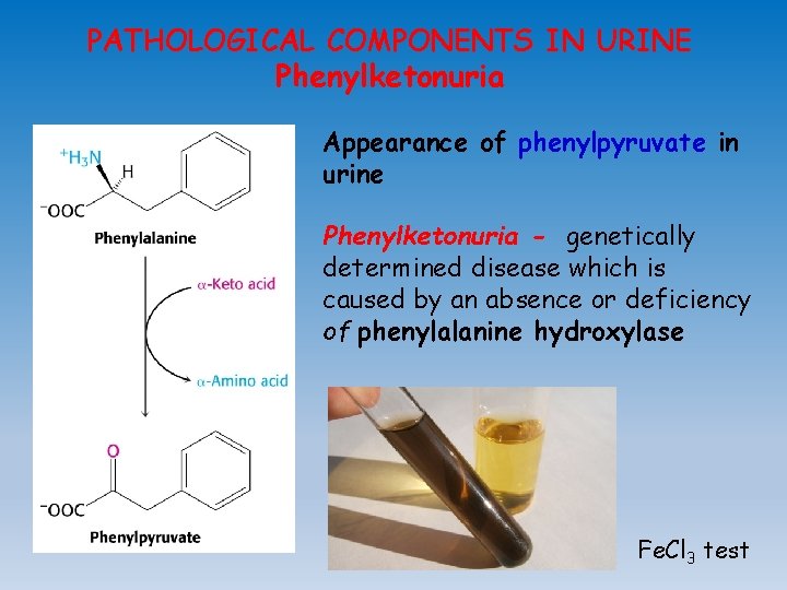 PATHOLOGICAL COMPONENTS IN URINE Phenylketonuria Appearance of phenylpyruvate in urine Phenylketonuria - genetically determined