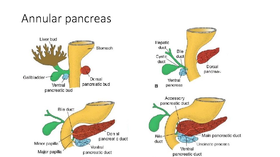 Annular pancreas 