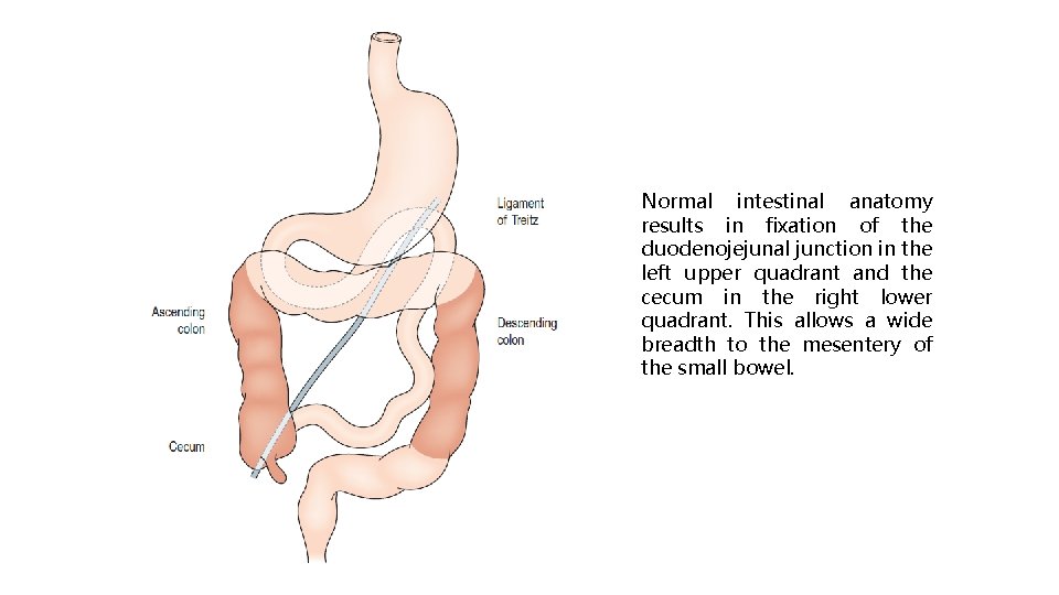 Normal intestinal anatomy results in fixation of the duodenojejunal junction in the left upper