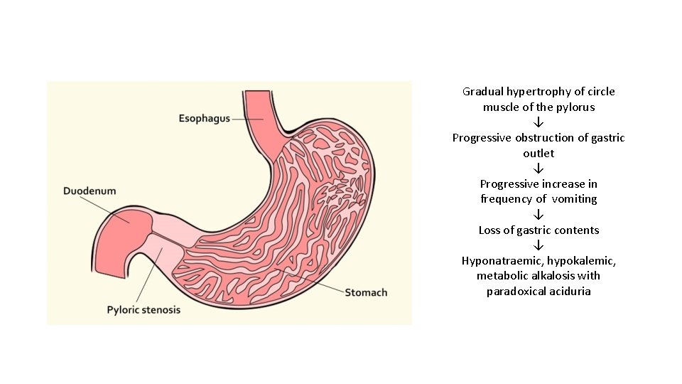 Gradual hypertrophy of circle muscle of the pylorus ↓ Progressive obstruction of gastric outlet