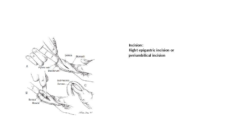 Incision: Right epigastric incision or periumbilical incision 