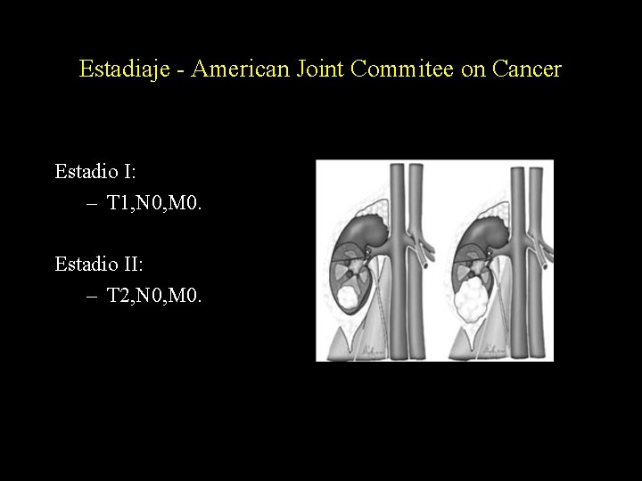 Estadiaje - American Joint Commitee on Cancer Estadio I: – T 1, N 0,