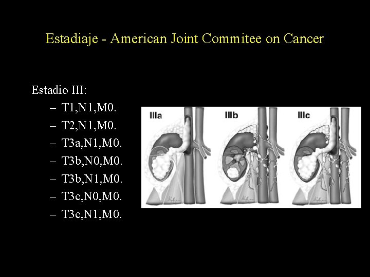 Estadiaje - American Joint Commitee on Cancer Estadio III: – T 1, N 1,