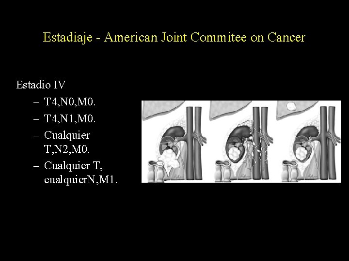 Estadiaje - American Joint Commitee on Cancer Estadio IV – T 4, N 0,