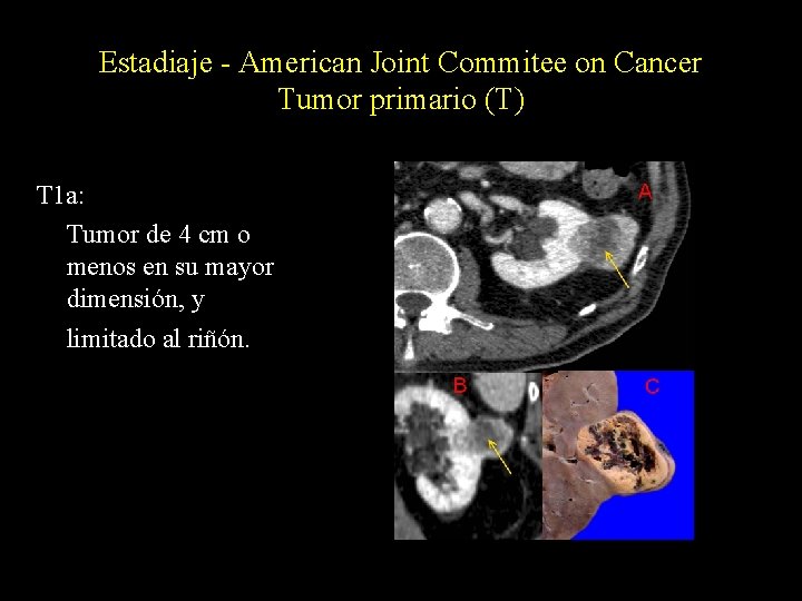 Estadiaje - American Joint Commitee on Cancer Tumor primario (T) T 1 a: Tumor